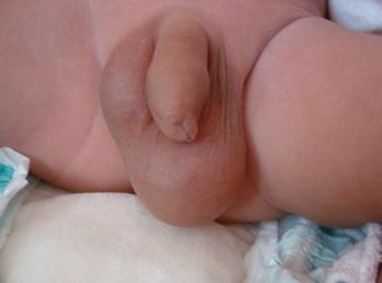 鞘膜積液的癥狀有哪些